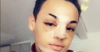 Pabllo Vittar faz plástica e outras duas cirurgias no nariz.